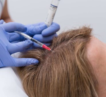 Ispadanje kose-koji su uzroci i kako se liječi